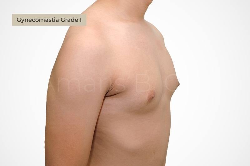 Grade 1 gynecomastia mild puffy nipple appearance male chest