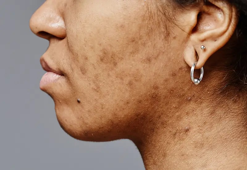 Post-inflammatory Hyperpigmentation (PIH) Singapore | Types of Acne Scars & Marks