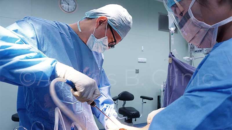 Dr Ivan Puah performing liposuction surgery in an operating theatre, Singapore