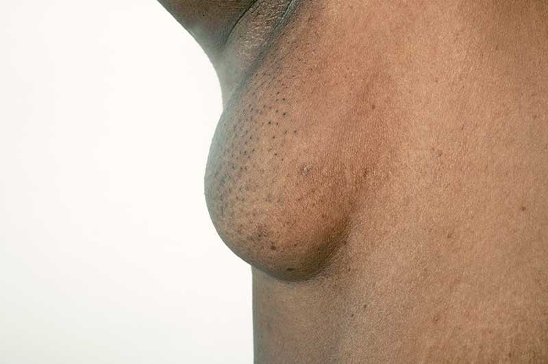 Accessory breast