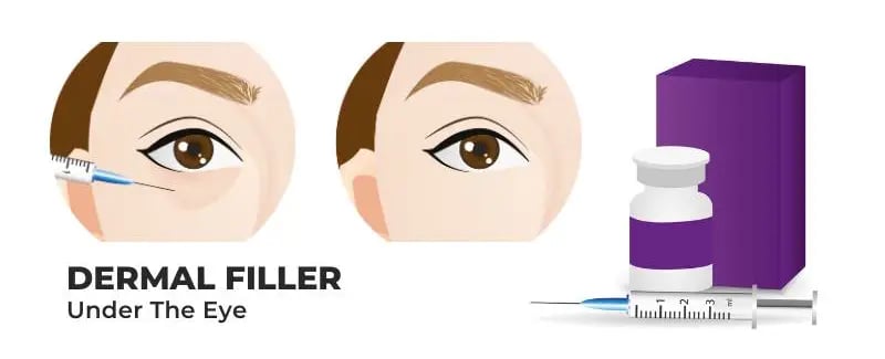 Tear Trough Fillers