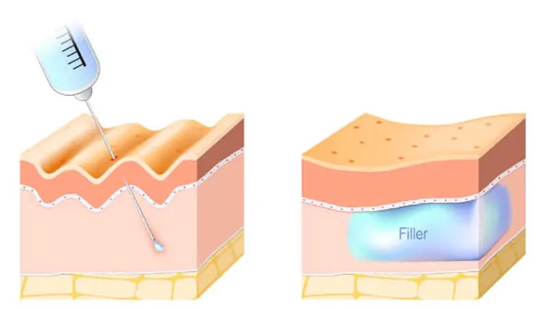 Dermal Fillers