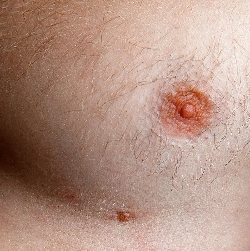 Axillary Breast Tissue in Men