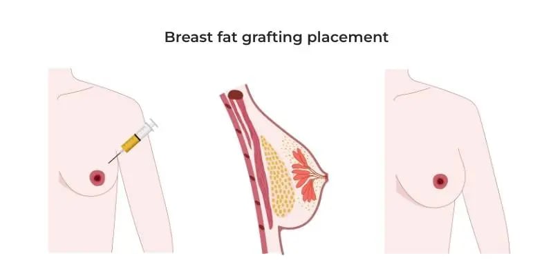 Breast fat grafting placement