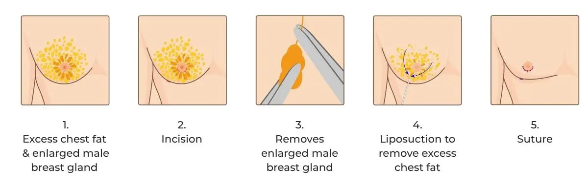DR IVAN PUAH’S SCARLESS GYNECOMASTIA SURGERY 360°GTD® TECHNIQUE