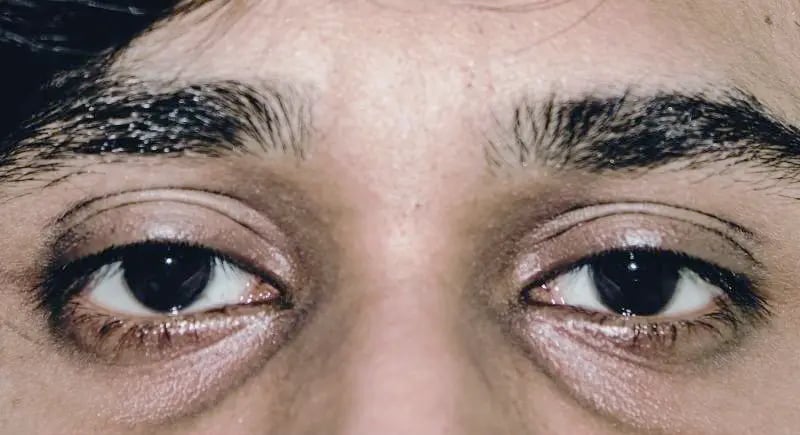 Dark Circles & Tear Troughs: Responsible For Making You Look Aged