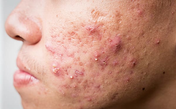 Acne and post-acne skin woes 