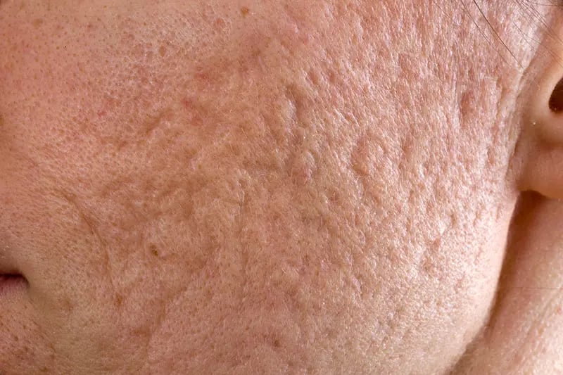 Rolling Acne Scars Singapore | Types of Acne Scars & Marks