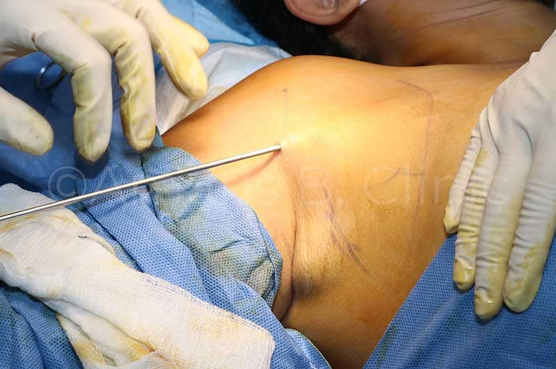 Permanent armpit fat and accessory breast removal by Dr Ivan Puah, Amaris B. Clinic