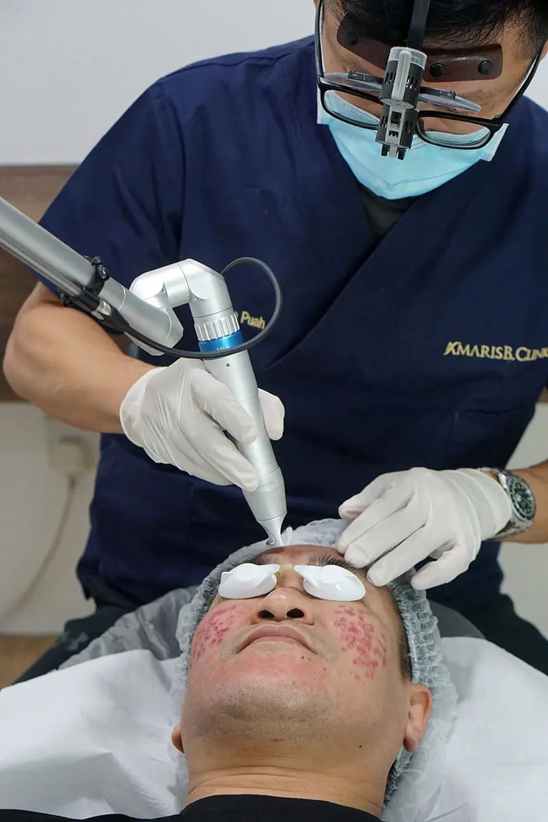 Treating Acne Scars with Pico Fractional Laser in Singapore | Types of Acne Scars & Marks