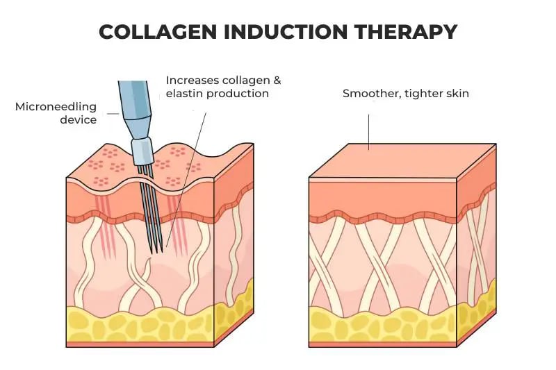 RF Microneedling with Erbium laser for a fresher-looking pair of eyes