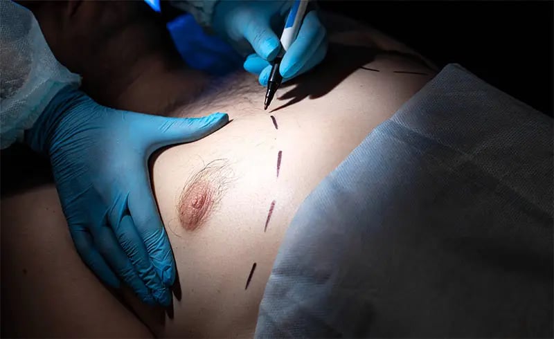 Crater Deformity After Gynecomastia Surgery