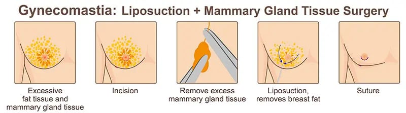 Gynecomastia surgery