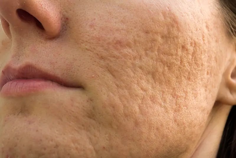 Boxcar Acne Scars Singapore | Types of Acne Scars & Marks