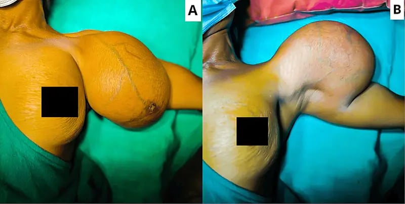 accessory breast tissue mimicking lipoma