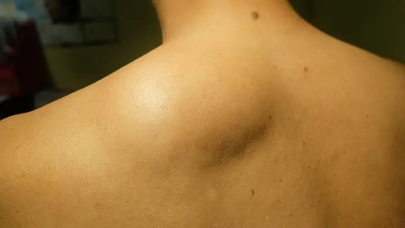 Lipoma on the shoulder