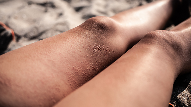 how to lose fat thighs and thigh chafing
