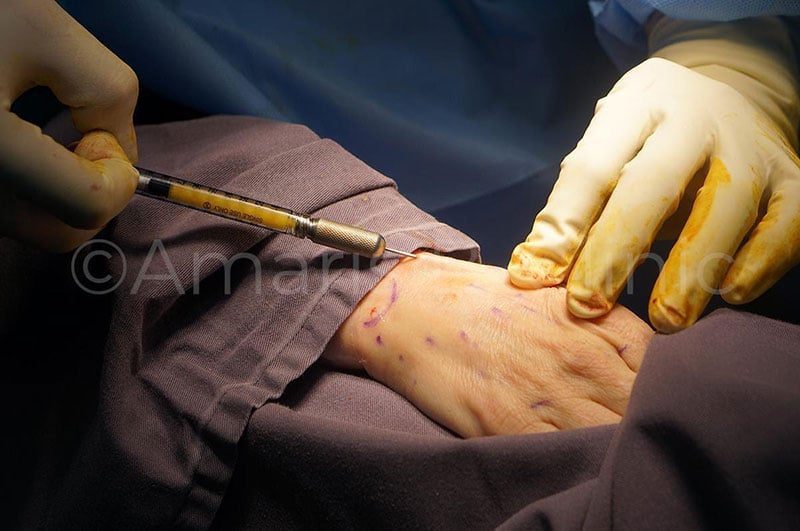 Hand Rejuvenation with Fat Grafting with Dr Ivan Puah