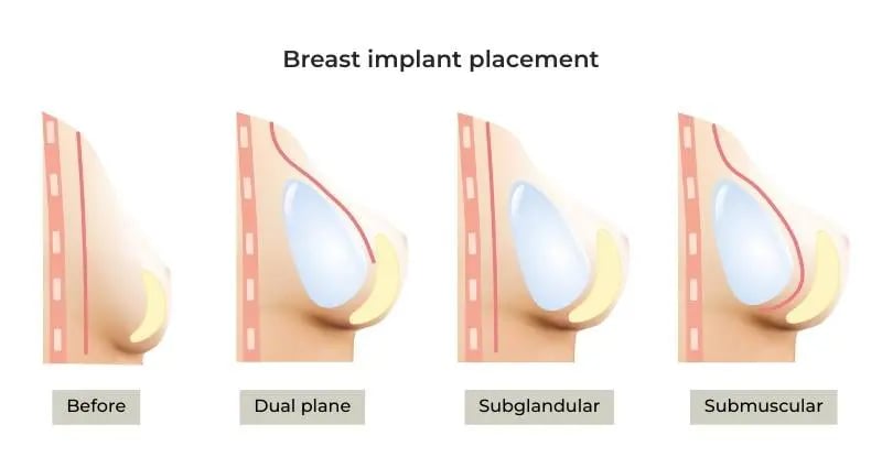 Breast implant placement