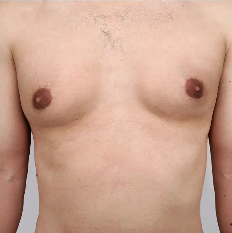 Suitable candidates for gynecomastia corrective surgery
