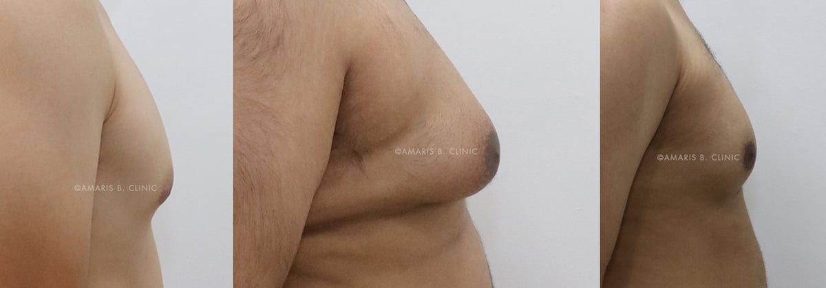How do I know if I have Gynecomastia or Pseudogynecomastia?
