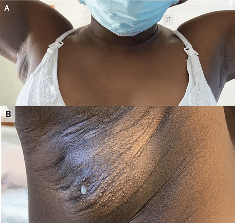 Lactating accessory breast