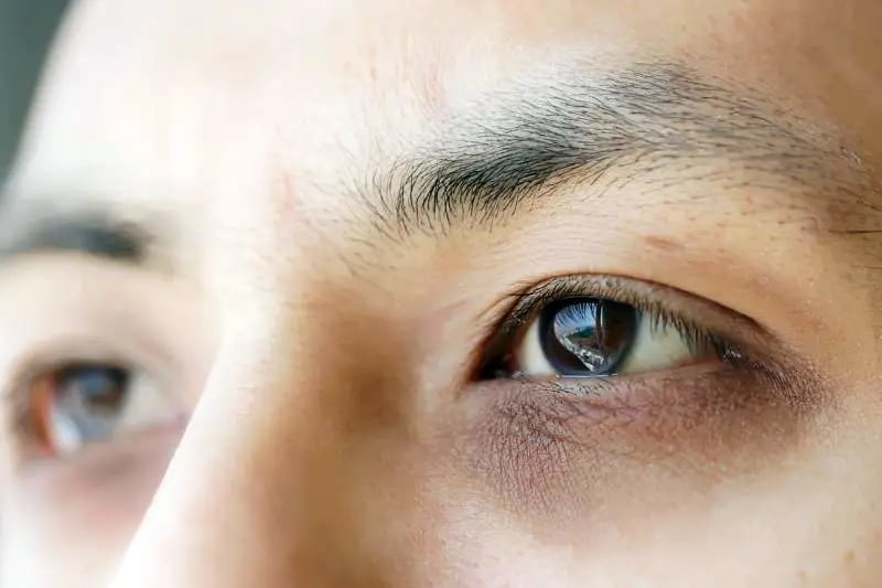 Dark Circles & Tear Troughs: Responsible For Making You Look Aged