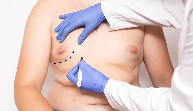 Pseudogynecomastia Surgery Cost in Singapore