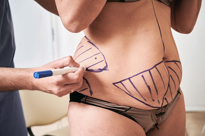 Tummy lipo