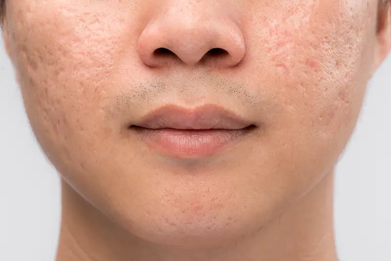 Ice Pick Acne Scars Singapore | Types of Acne Scars & Marks