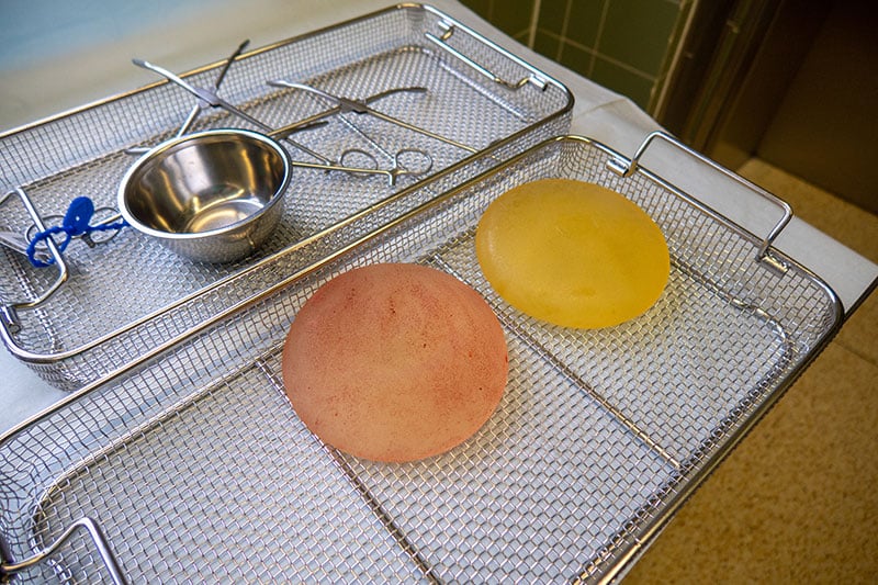 Breast Explant: Patients may also suffer from breast implant illness (BII) that presents symptoms such as fatigue, joint pain, brain fog and dry eyes. This has led to a rise in breast explant surgery.