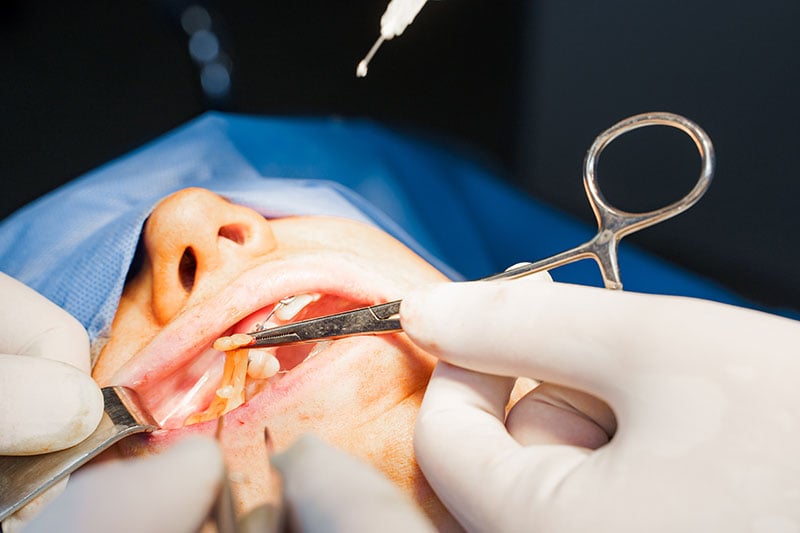 Buccal fat removal surgery
