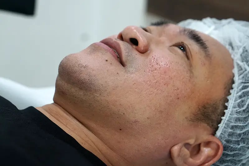 FAQ on acne scars and Pico Fractional Laser in Singapore | Types of Acne Scars & Marks