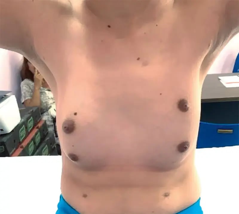 Accessory breast Singapore Dr Ivan Puah Amaris B. Clinic