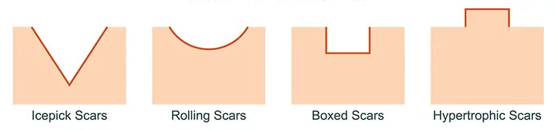 Acne scars Singapore | Types of Acne Scars & Marks