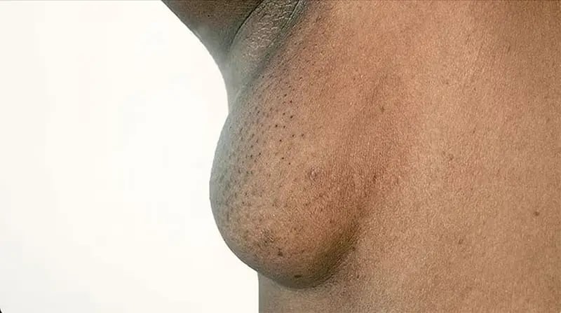 Axillary Breast Tissue in Women